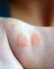 Dermatite atópica: quando o desconforto é a nossa própria pele